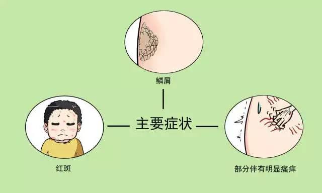 银屑病最新治疗方法的研究与进展概述