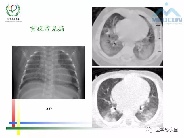 最新肺病研究及治疗进展综述